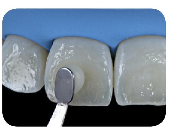 Sof-Lex™ Finishing Strips
