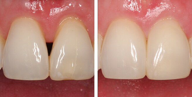 black triangle restoration teeth before and after
