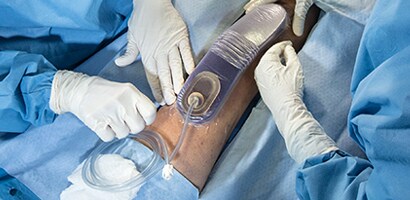 PREVENA™ Therapy in surgical setting
